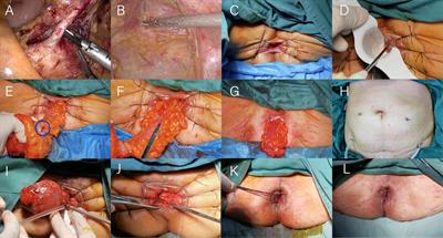 Application of laparoscopic modified Bacon operation in patients with low rectal cancer and analysis of the changes in anal function: A retrospective single-center study